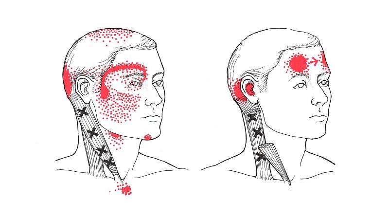 Cervicogenic Headache
