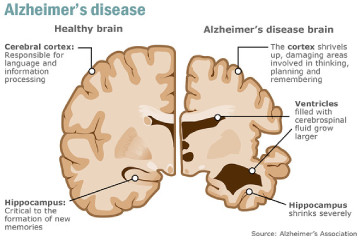 alzheimer-disease - Dr. Khushbu Goel alzheimer-disease