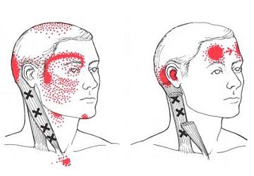 cervicogenic-headache - Dr. Khushbu Goel cervicogenic-headache