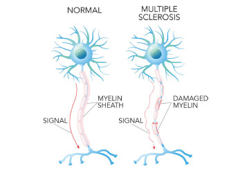 multiple-sclerosis