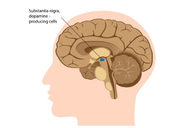 parkinson disease - Dr. Khushbu Goel parkinson disease