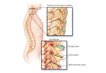 spondylosis - Dr. Khushbu Goel spondylosis