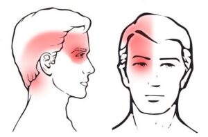 What Is Cervicogenic Headache.