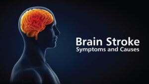 A stroke is a brain injury caused by a disruption of blood flow to the brain